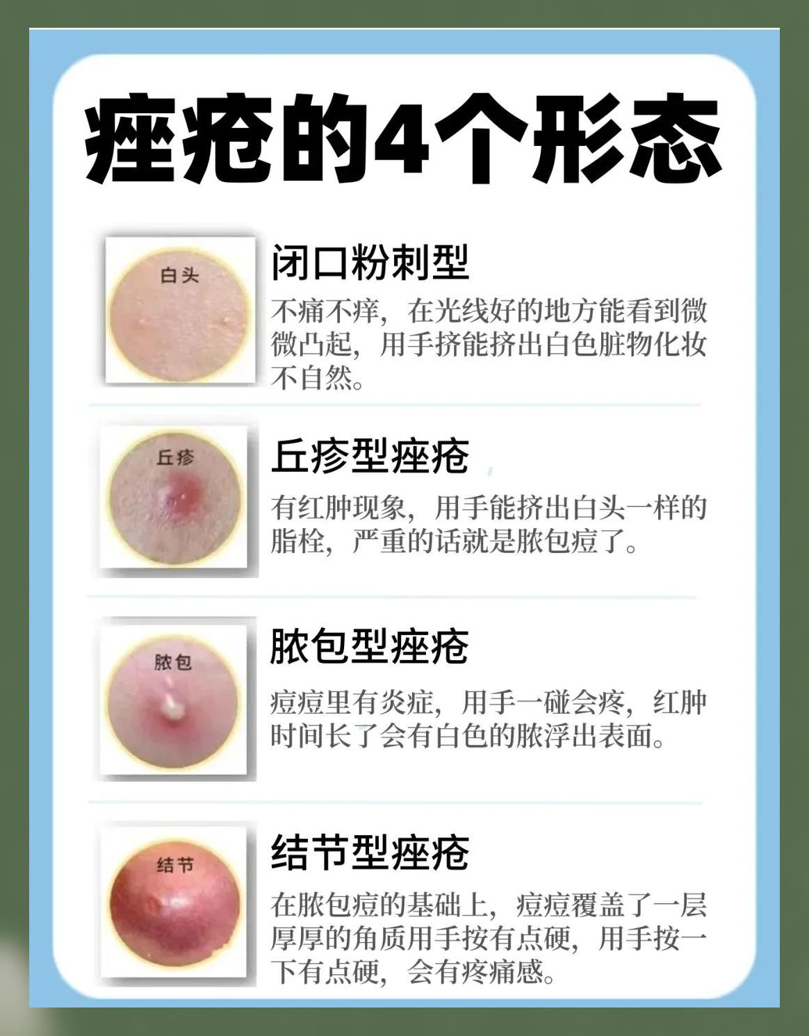 痘痘痘印怎么去除(痘坑痘印怎么消除男生)