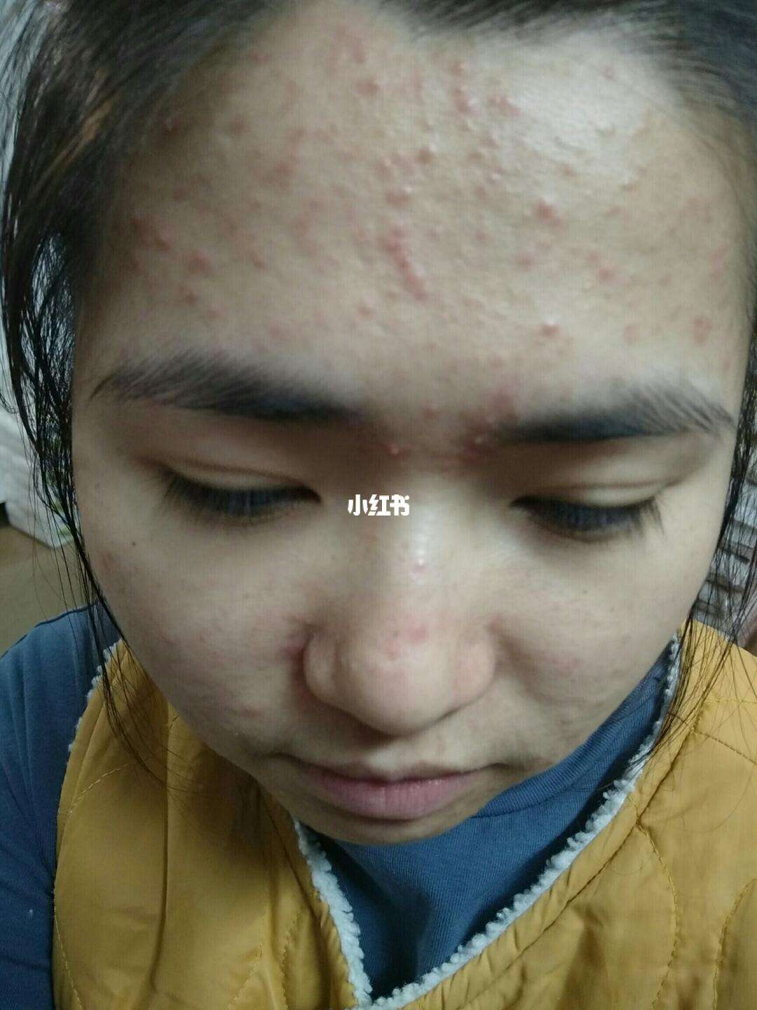 丘疹型痘痘(丘疹型痘痘用什么药膏最有效)