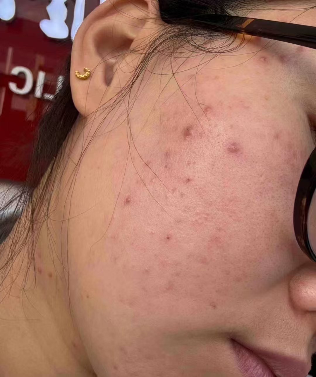 丘疹型痘痘(丘疹型痘痘用什么药膏最有效)