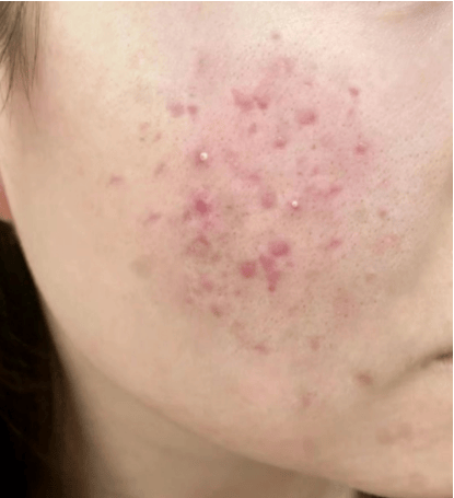 痘痘已经平了一直红着(痘痘已经平了一直红着可以吃消炎药吗)