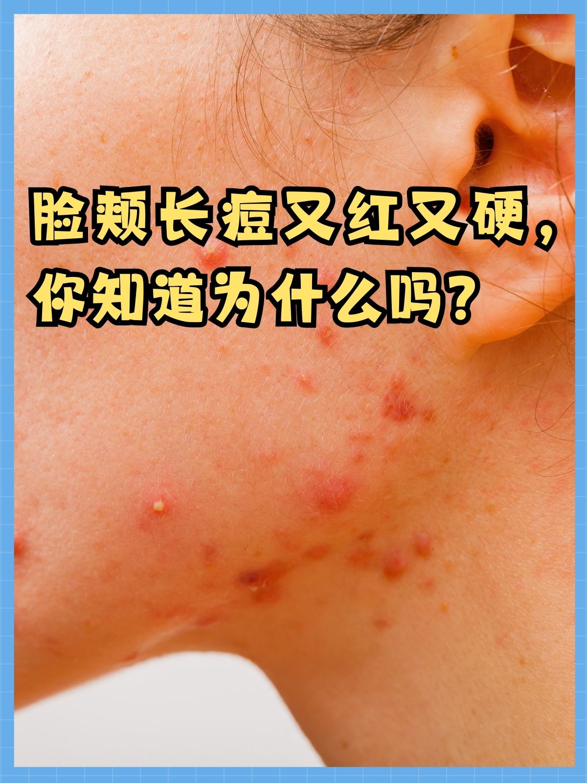 痘痘已经平了一直红着(痘痘已经平了一直红着可以吃消炎药吗)