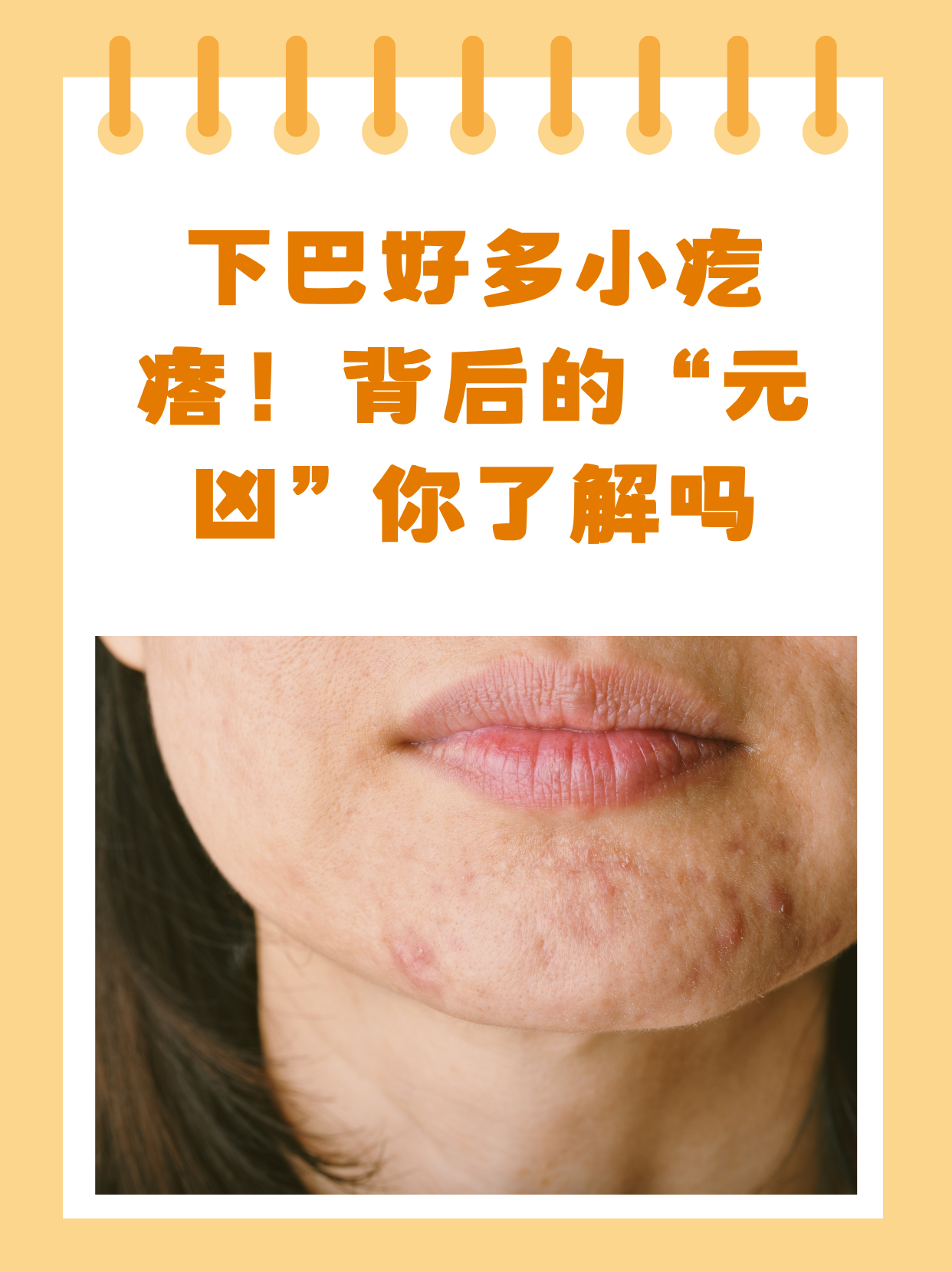 下巴长痘痘是什么原因(下巴长痘痘是什么原因主哪个脏腑)