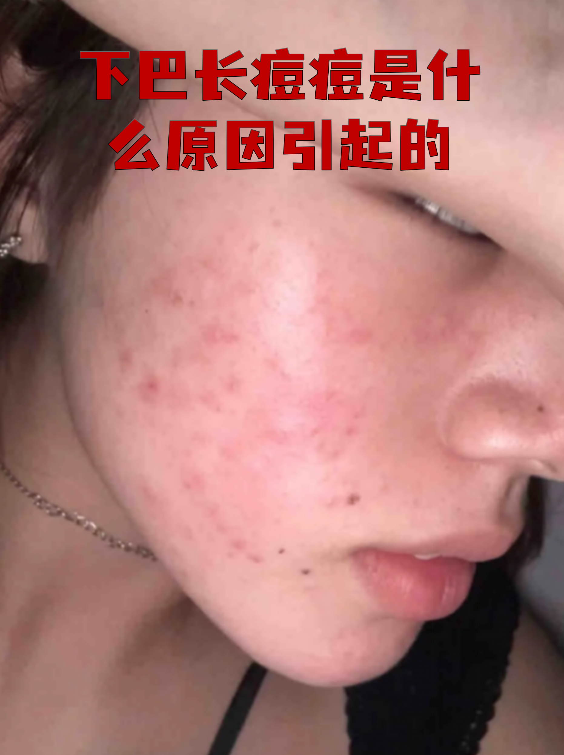 下巴起痘痘是怎么回事(下巴起痘痘是怎么回事什么原因)