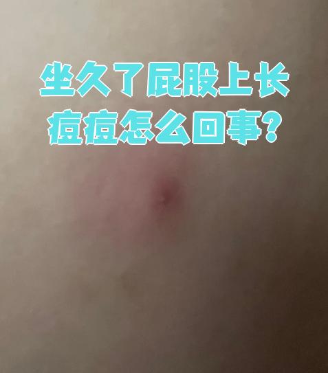 屁股长痘痘怎么回事(屁股长痘痘怎么回事用什么药膏)