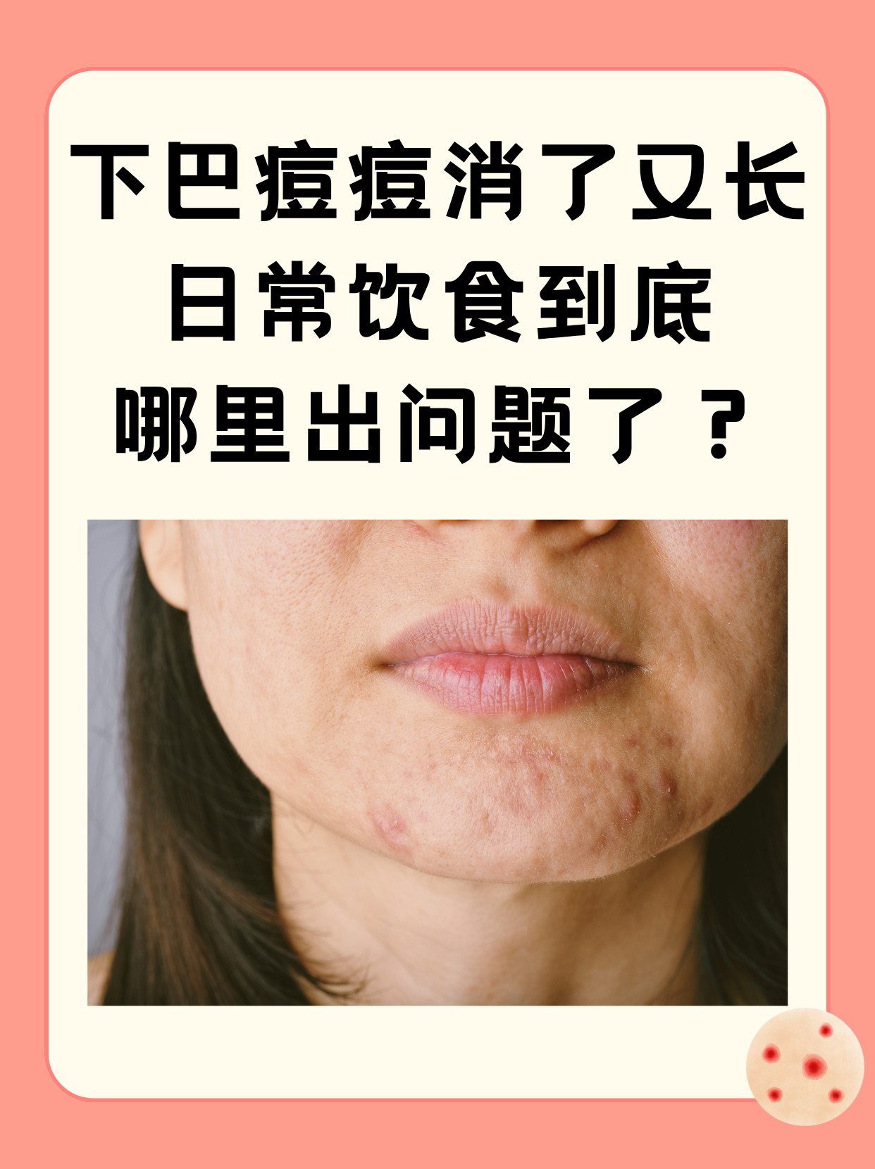 下巴长痘痘是什么原因引起的(下巴长痘痘是什么原因引起的女性)