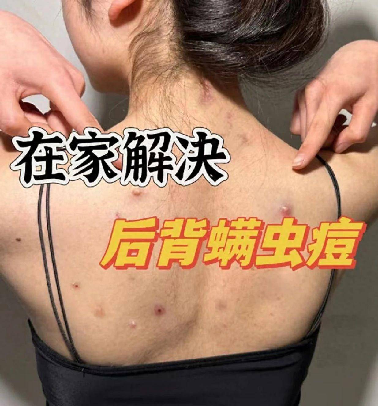 后背长痘痘是什么原因引起的(后背长痘痘是怎么消除)