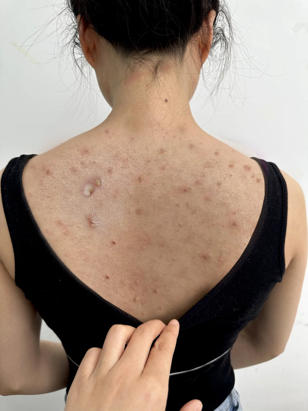 背上长痘痘(背上长痘痘怎么消除最快方法)