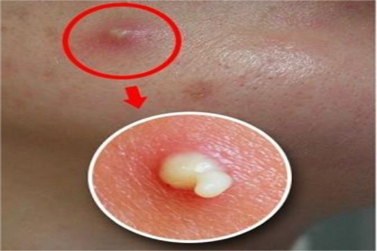 痘痘挤出来的白色东西是什么(身上出现痘痘能挤出白点)