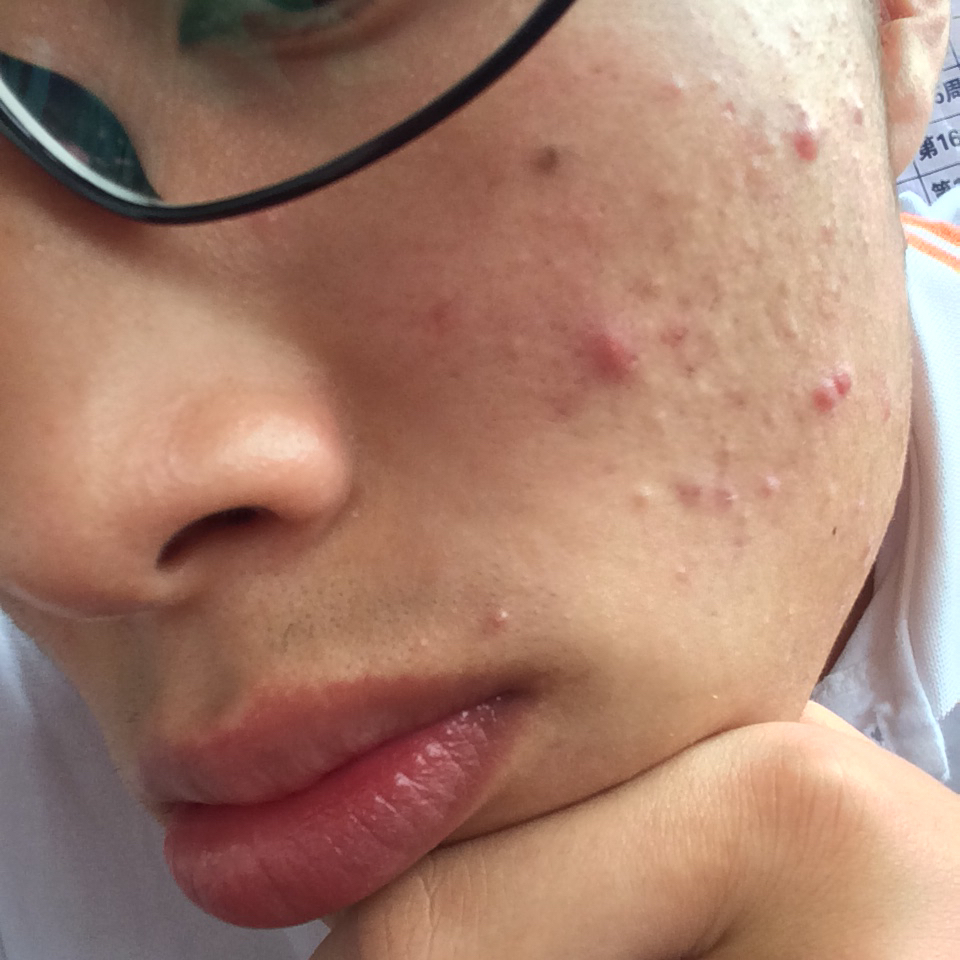 囊肿型痘痘(囊肿型痘痘怎么办)