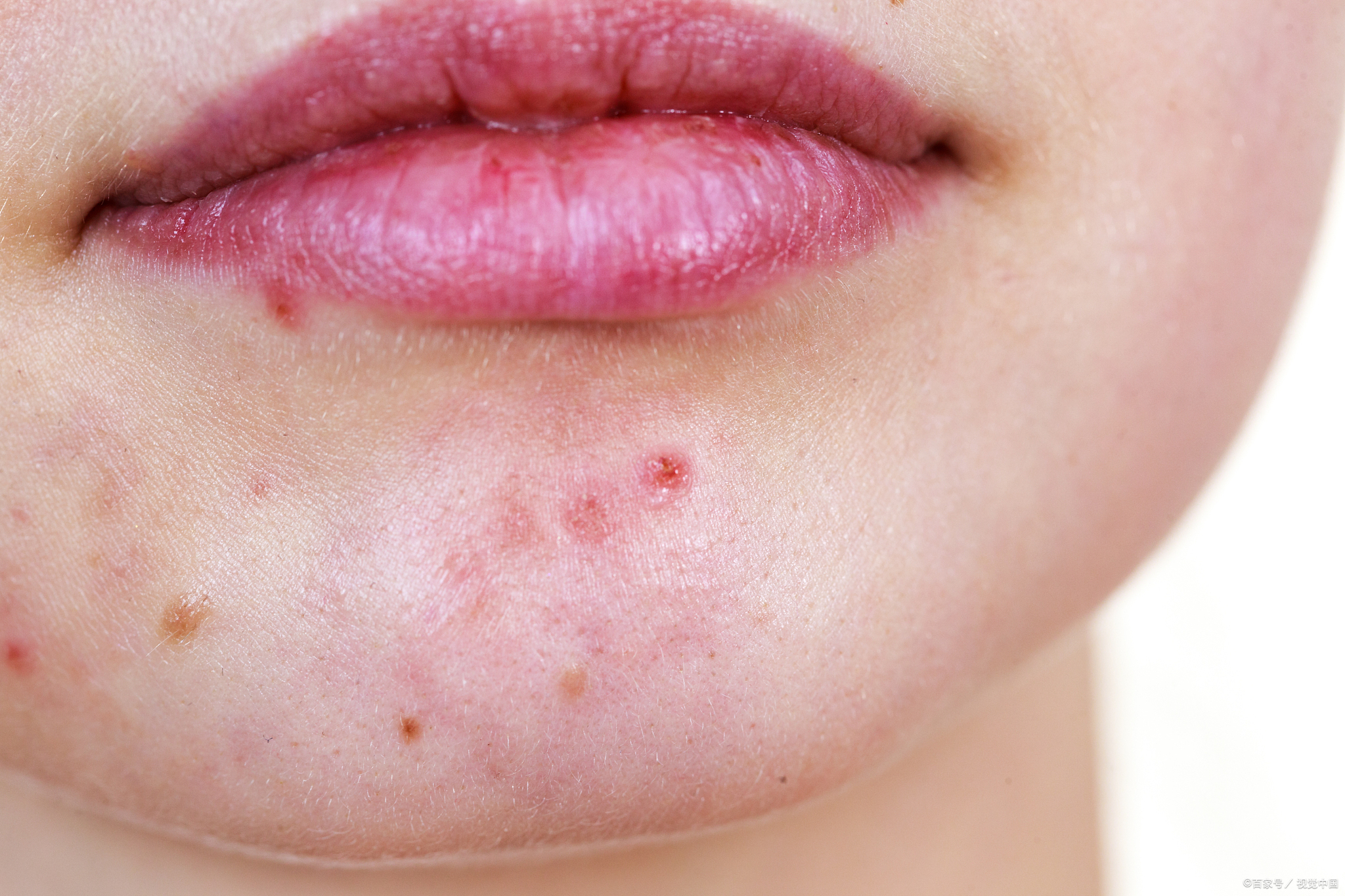 嘴角长痘痘(嘴角长痘痘吃什么食物好得快)