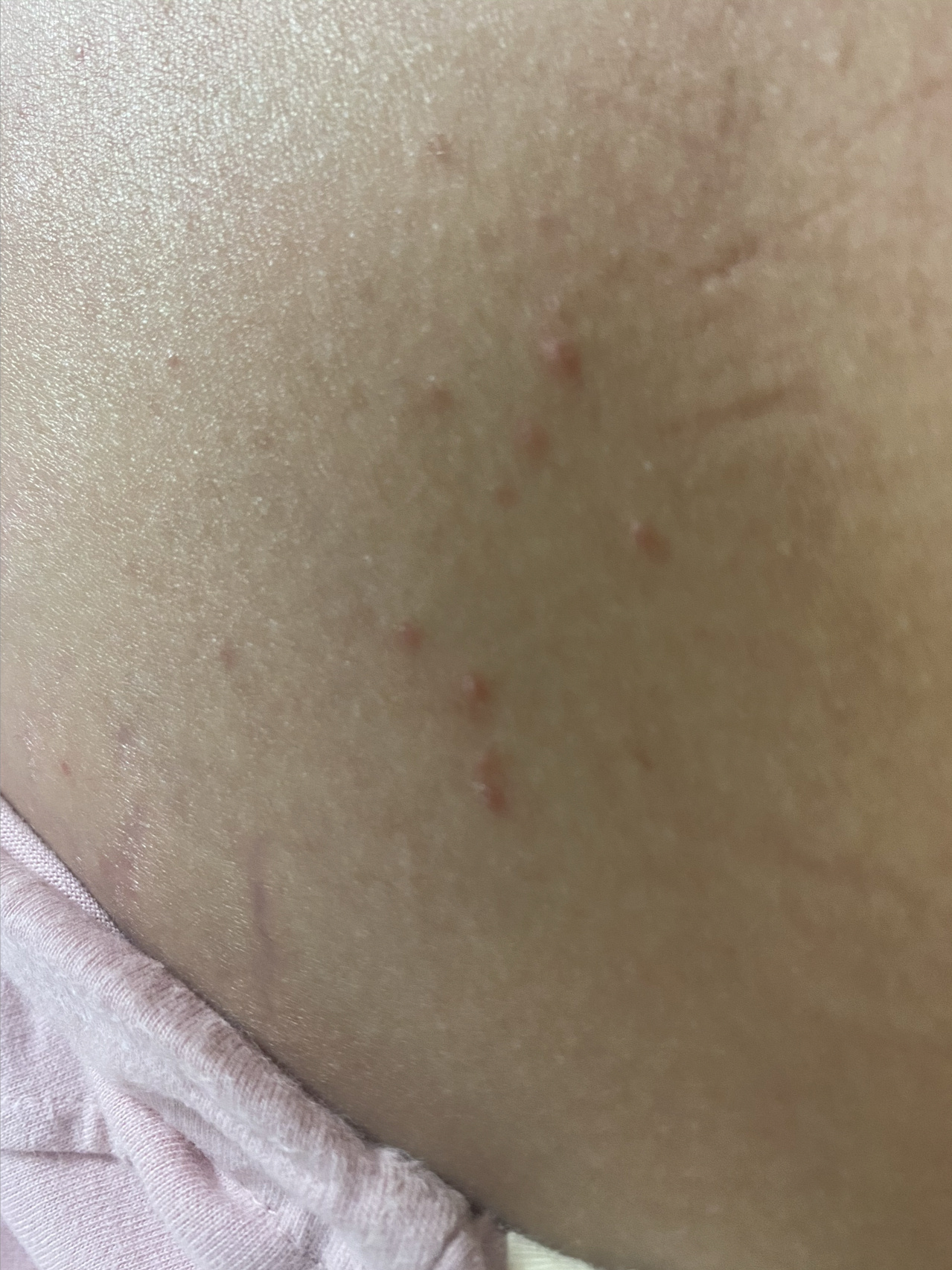 怀孕会长痘痘吗(怀孕会长痘痘吗下巴)