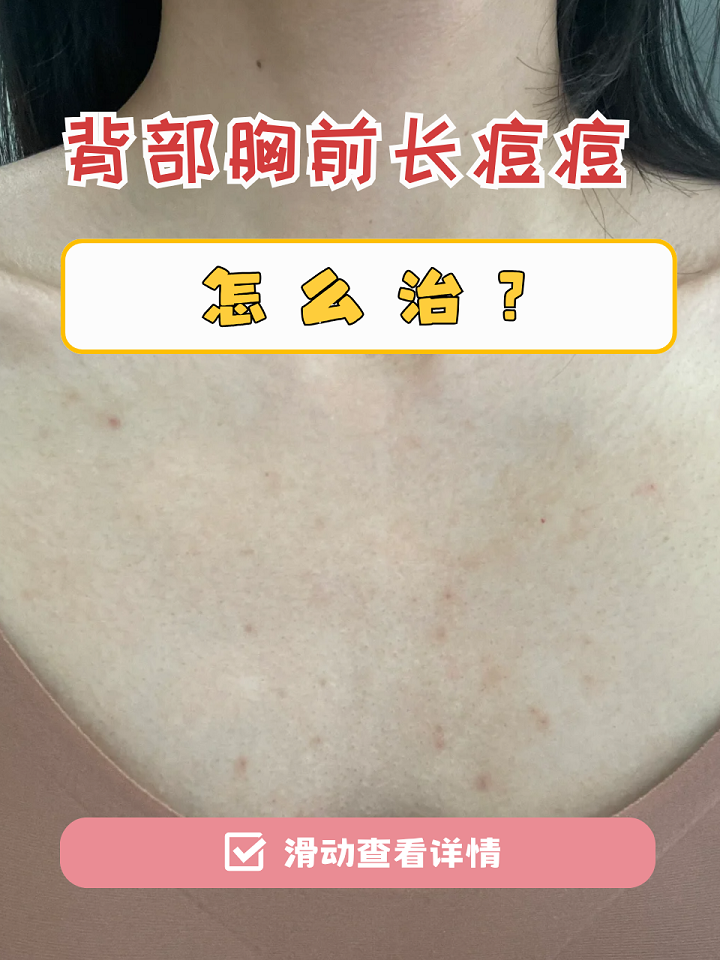 女生背上和胸前长痘痘怎么办(女生背上胸上长痘痘的原因)