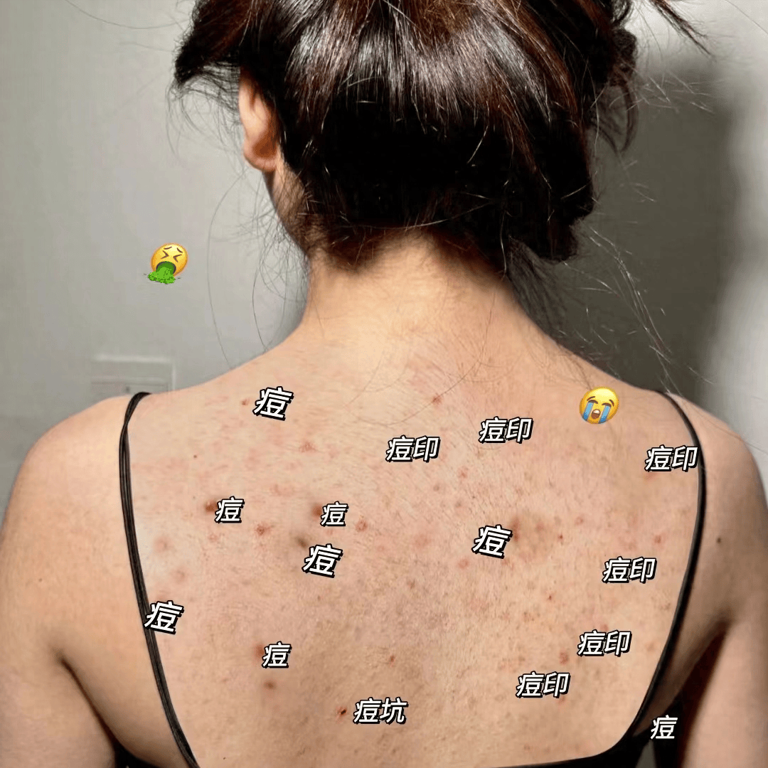 女生背上和胸前长痘痘怎么办(女生背上胸上长痘痘的原因)