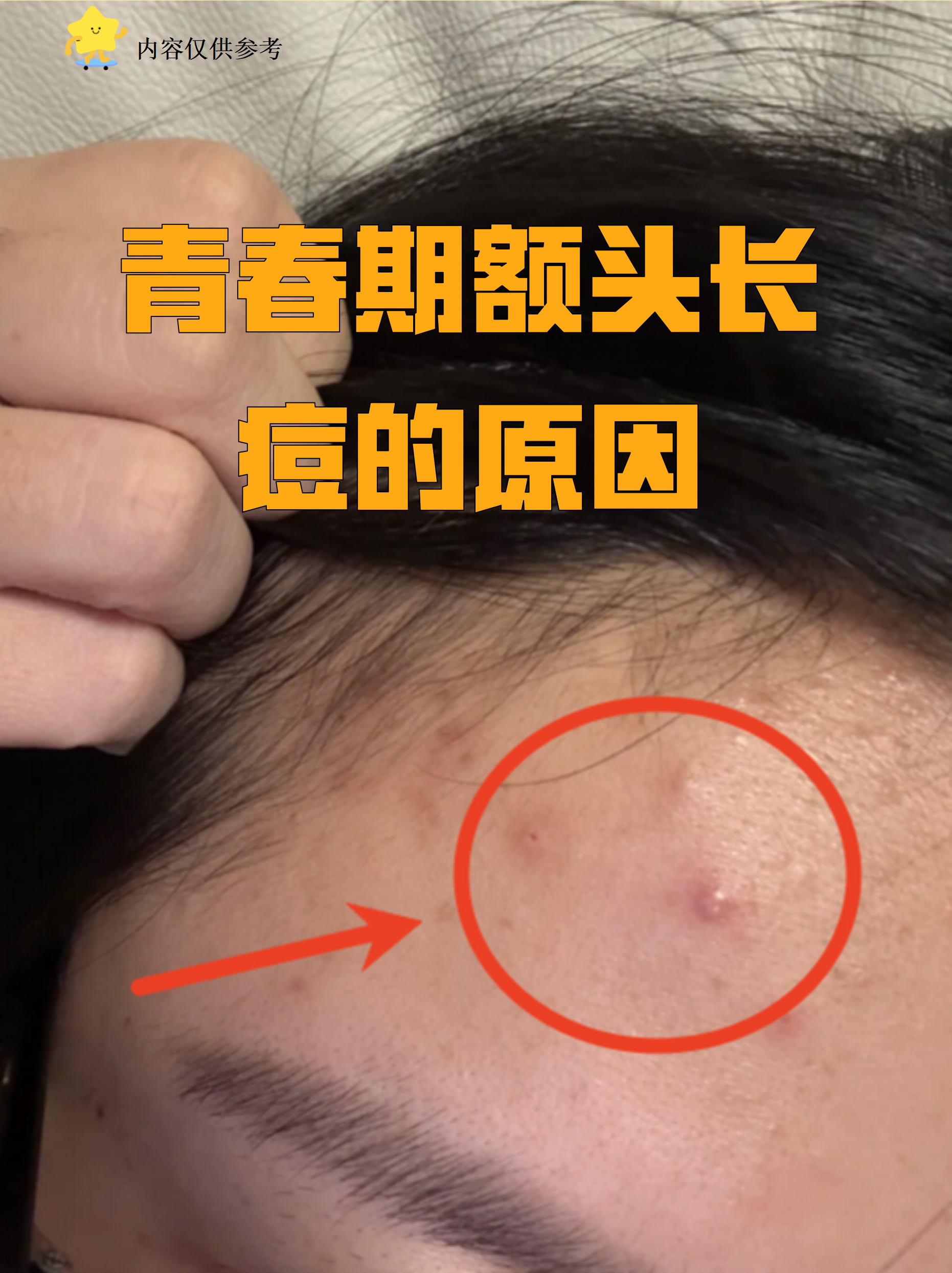 额头上长痘痘是什么原因(45岁额头上长痘痘是什么原因)