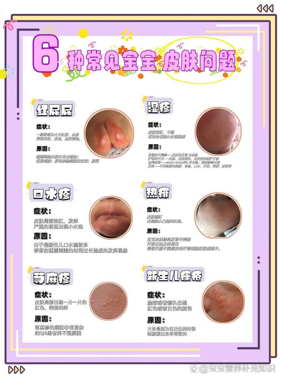 宝宝长痘痘有几种图片(宝宝长痘痘有几种图片和症状)