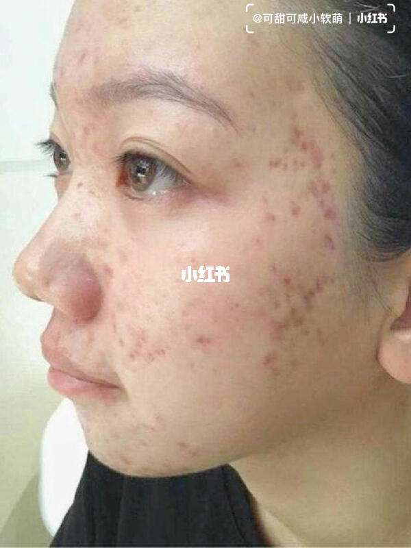 痘痘肌(痘痘肌吃什么食物清单)