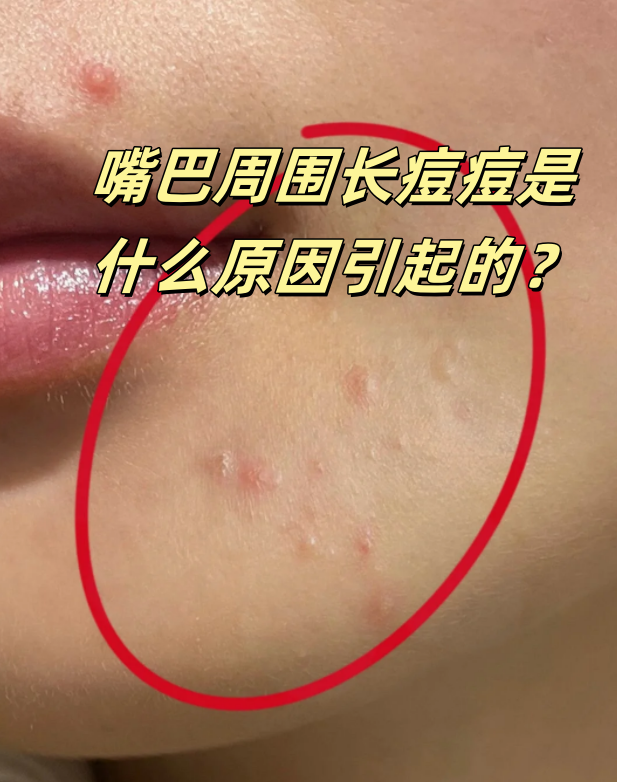 嘴巴周围长痘痘(嘴巴周围长痘痘是什么火)