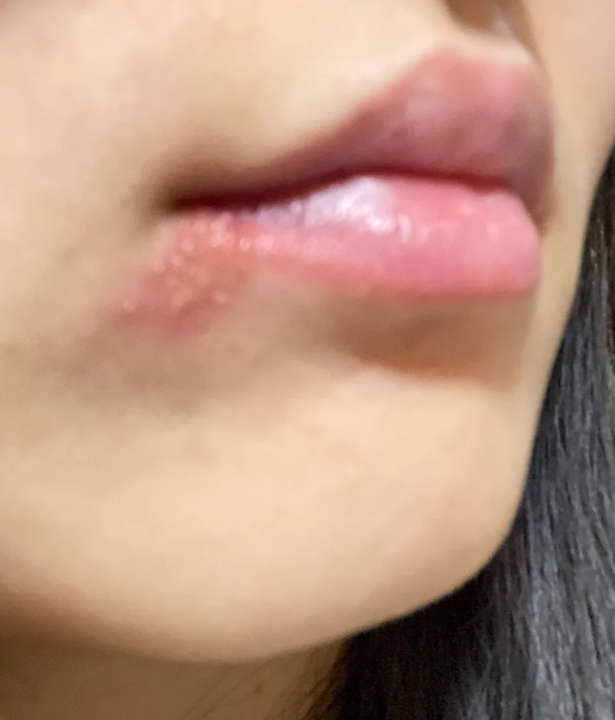 嘴巴周围长痘痘(嘴巴周围长痘痘是什么火)