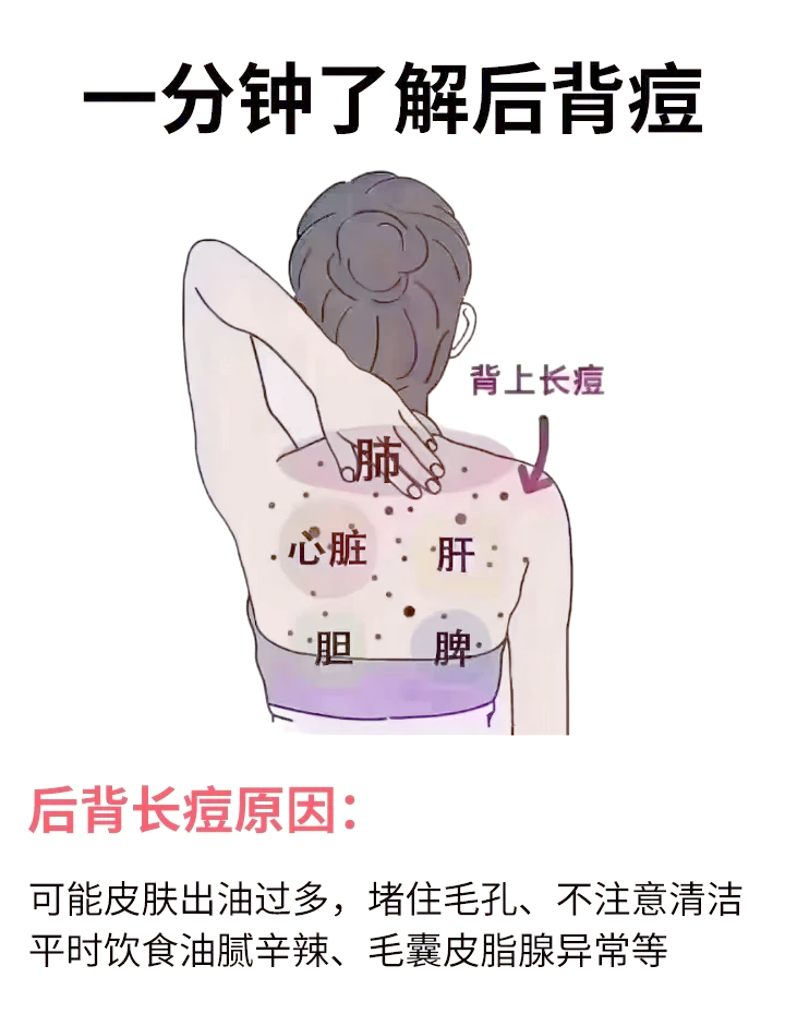 背上长痘痘怎么办(吃避孕药背上长痘痘怎么办)