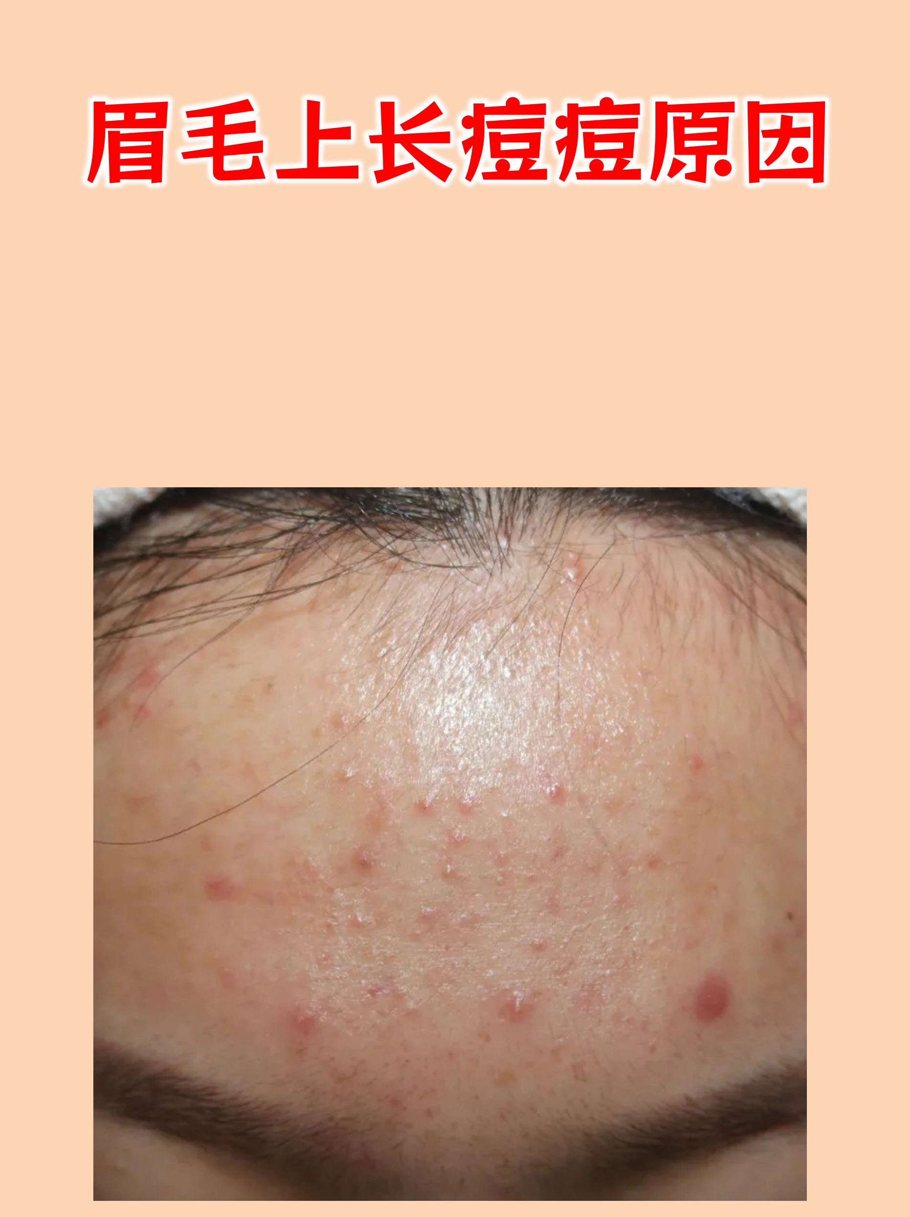 眉毛中间长痘痘是什么原因(眉头之间长痘痘什么原因)