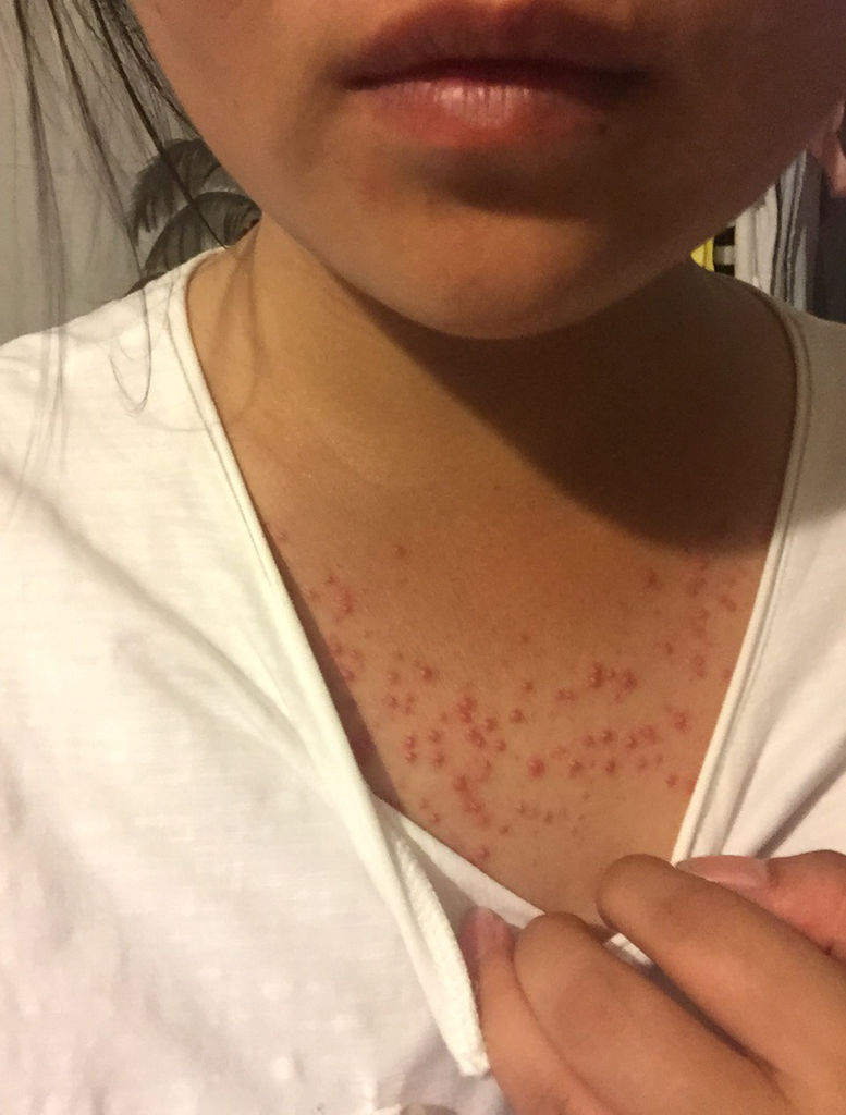 胸前长痘痘(胸前长痘痘一直不消怎么办)