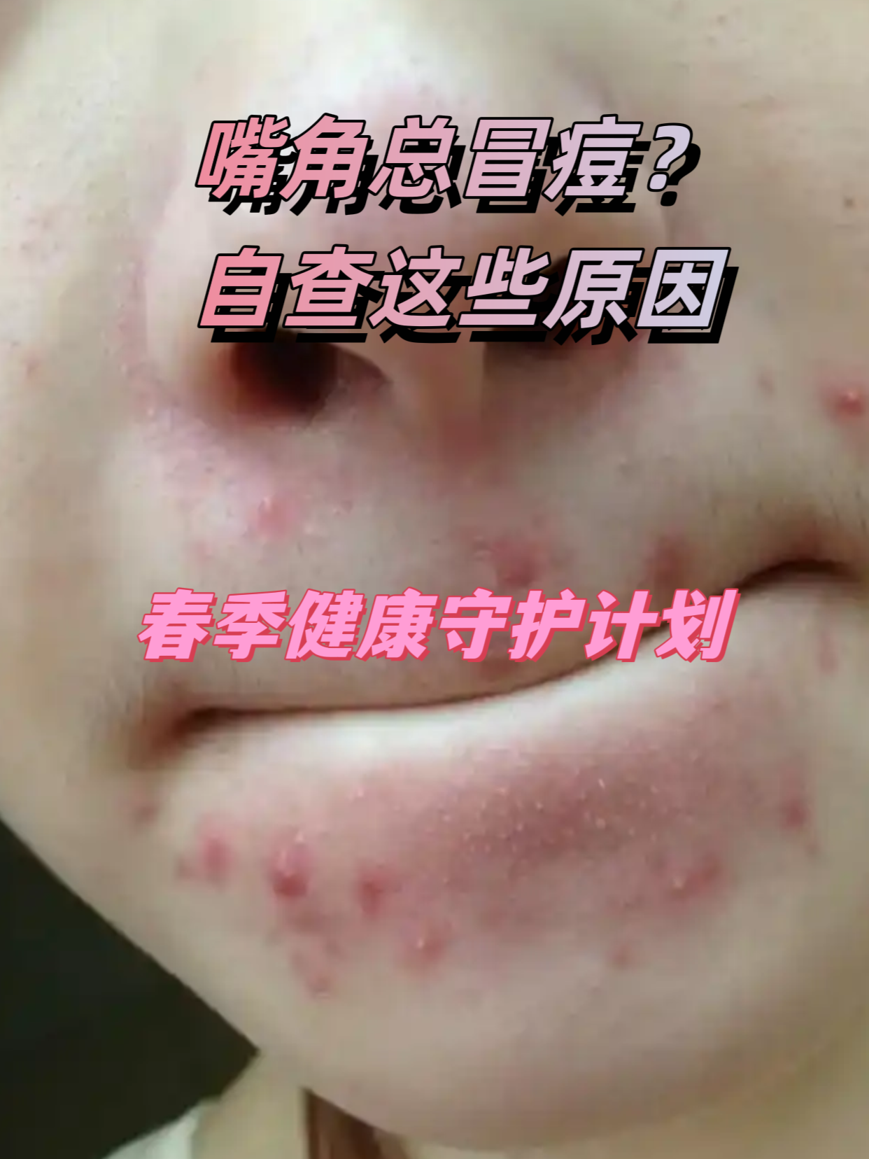 嘴角长痘痘是什么原因(经期嘴角长痘痘是什么原因)