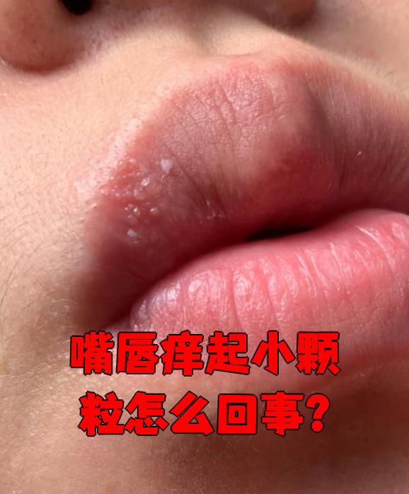 嘴角长痘痘是什么原因(经期嘴角长痘痘是什么原因)