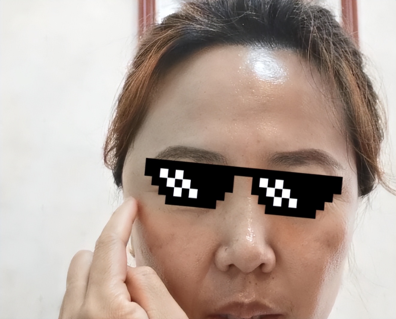 太阳穴长痘痘(太阳两侧长痘痘是什么原因是什么)