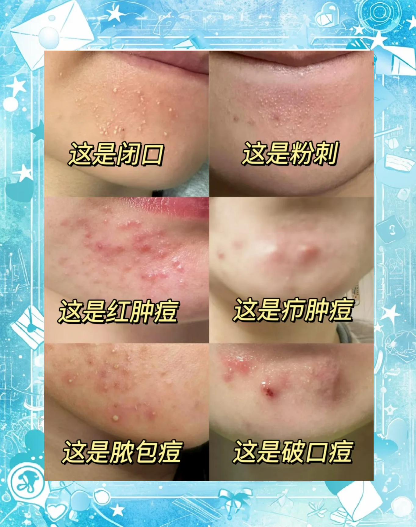 下巴长痘痘红肿硬硬的还疼怎么解决(突然下巴长痘痘红肿硬硬的还疼怎么解决)