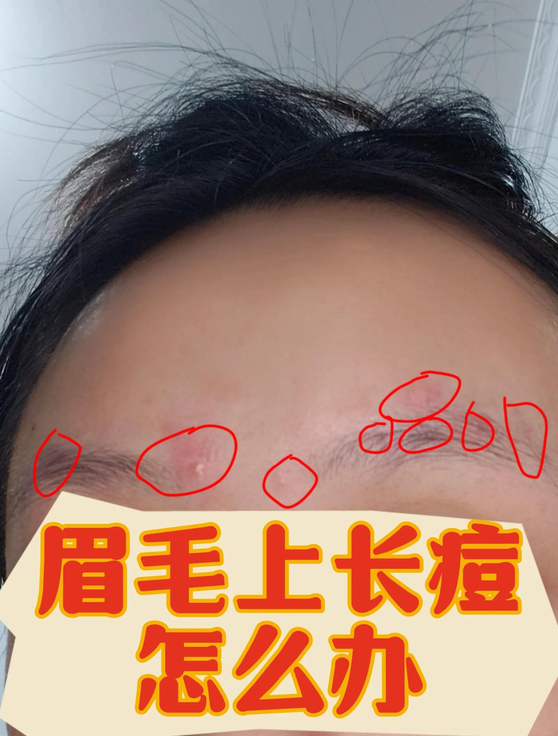 眉毛上长痘痘是什么原因(为什么眉毛上面会长痘痘)