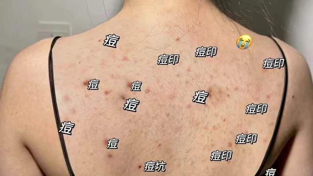 后背长痘痘怎么回事(男孩前胸后背长痘痘怎么回事)