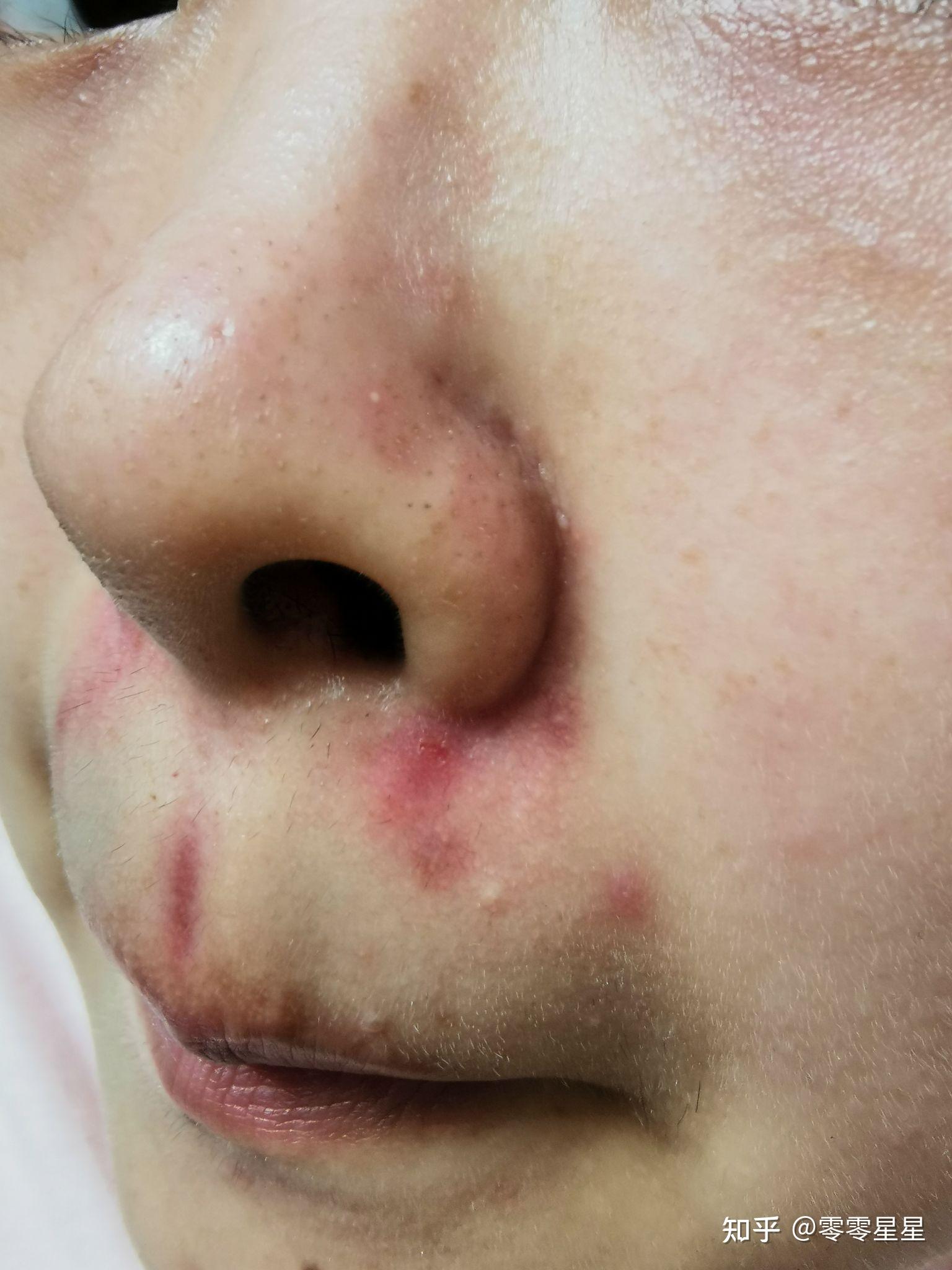 鼻子上长痘痘(鼻子上长痘痘是什么火)