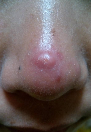 鼻子上长痘痘是什么原因(一岁宝宝鼻子上长痘痘是什么原因)