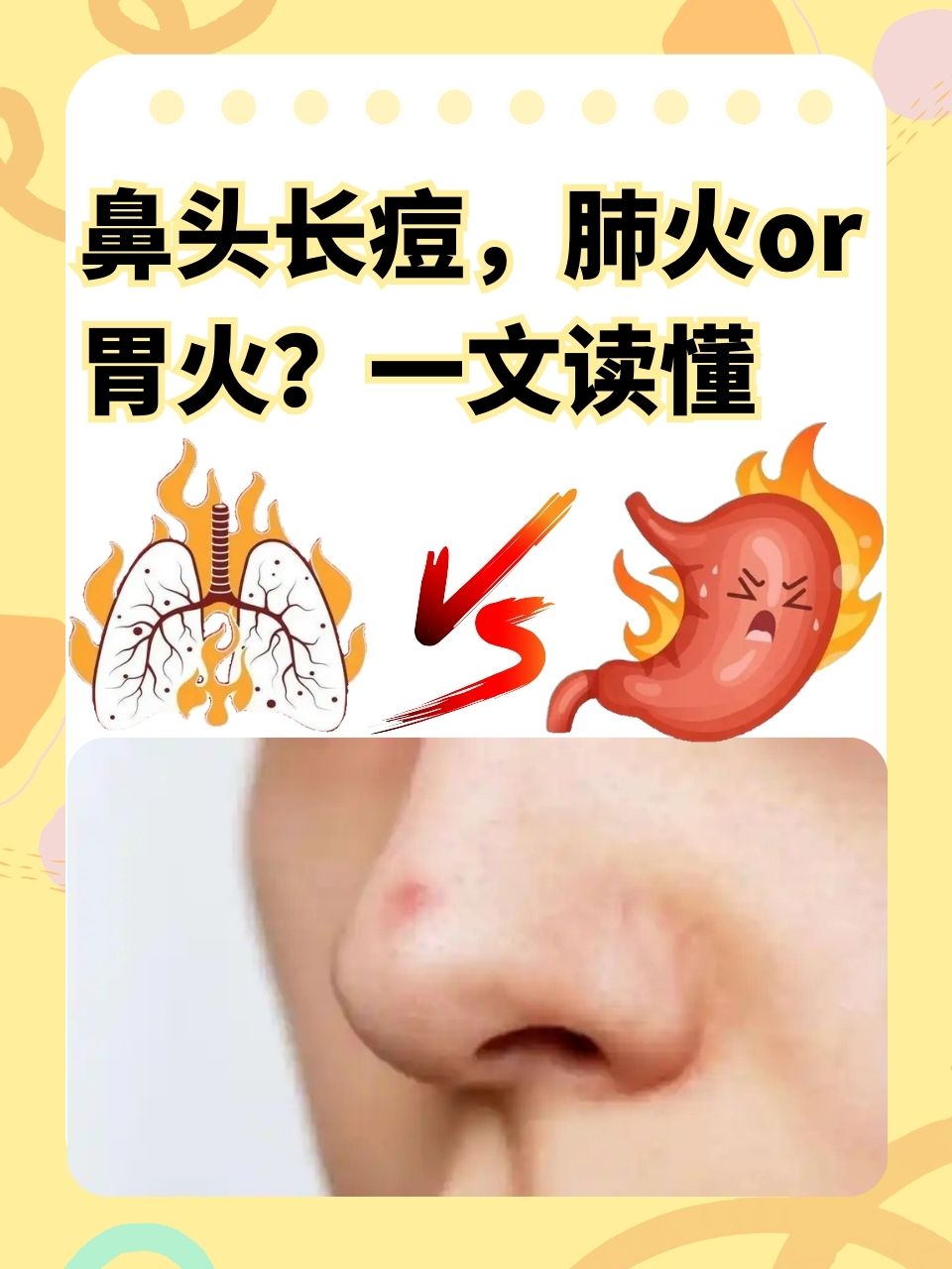 鼻子上长痘痘是什么原因(一岁宝宝鼻子上长痘痘是什么原因)