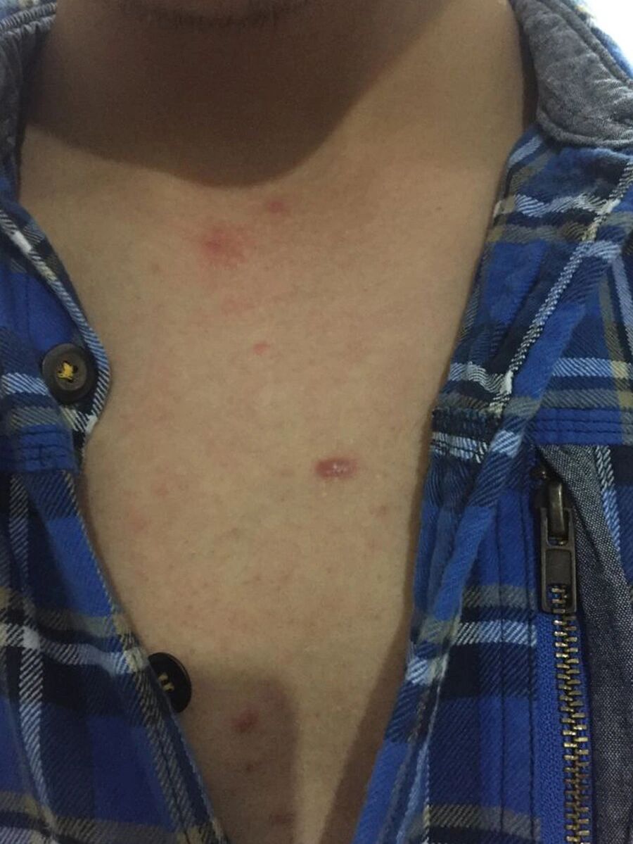 胸口长痘痘(胸口长痘痘是肝火旺盛吗)