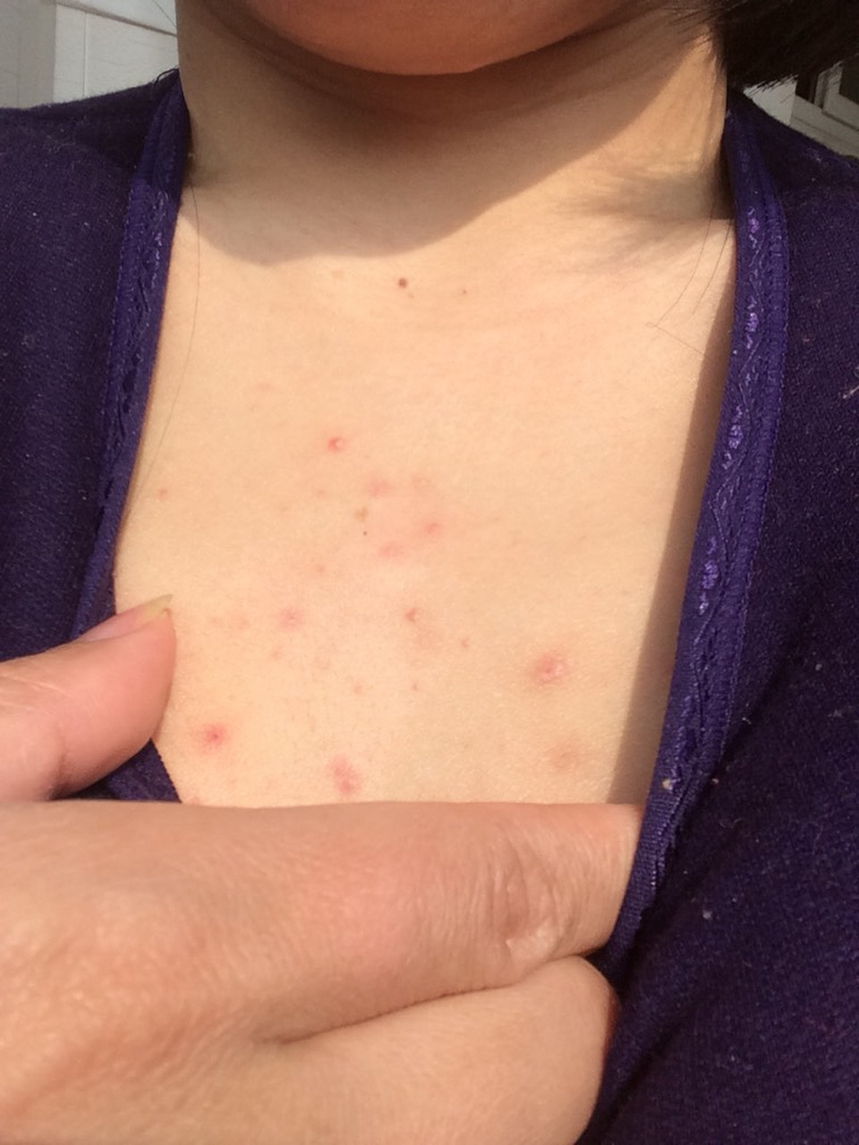 胸口长痘痘(胸口长痘痘是肝火旺盛吗)