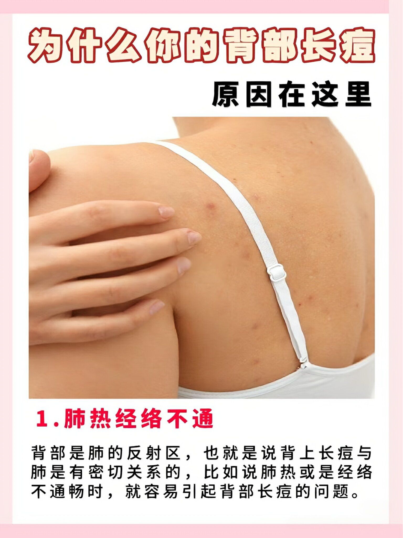 后背有痘痘怎么去除(后背痘痘怎么去除最有效的方法)