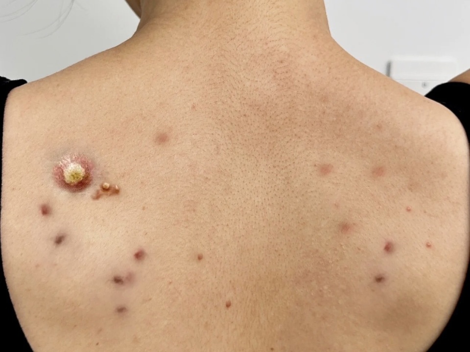 背部长痘痘是什么原因(脸部和背部长痘痘是什么原因)