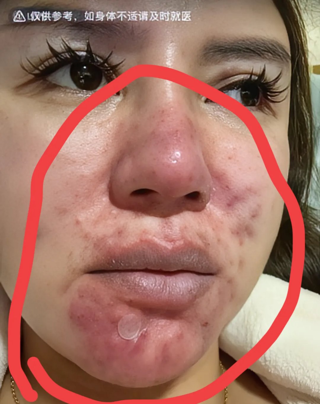 痘痘(痘痘的类型分为哪几种)