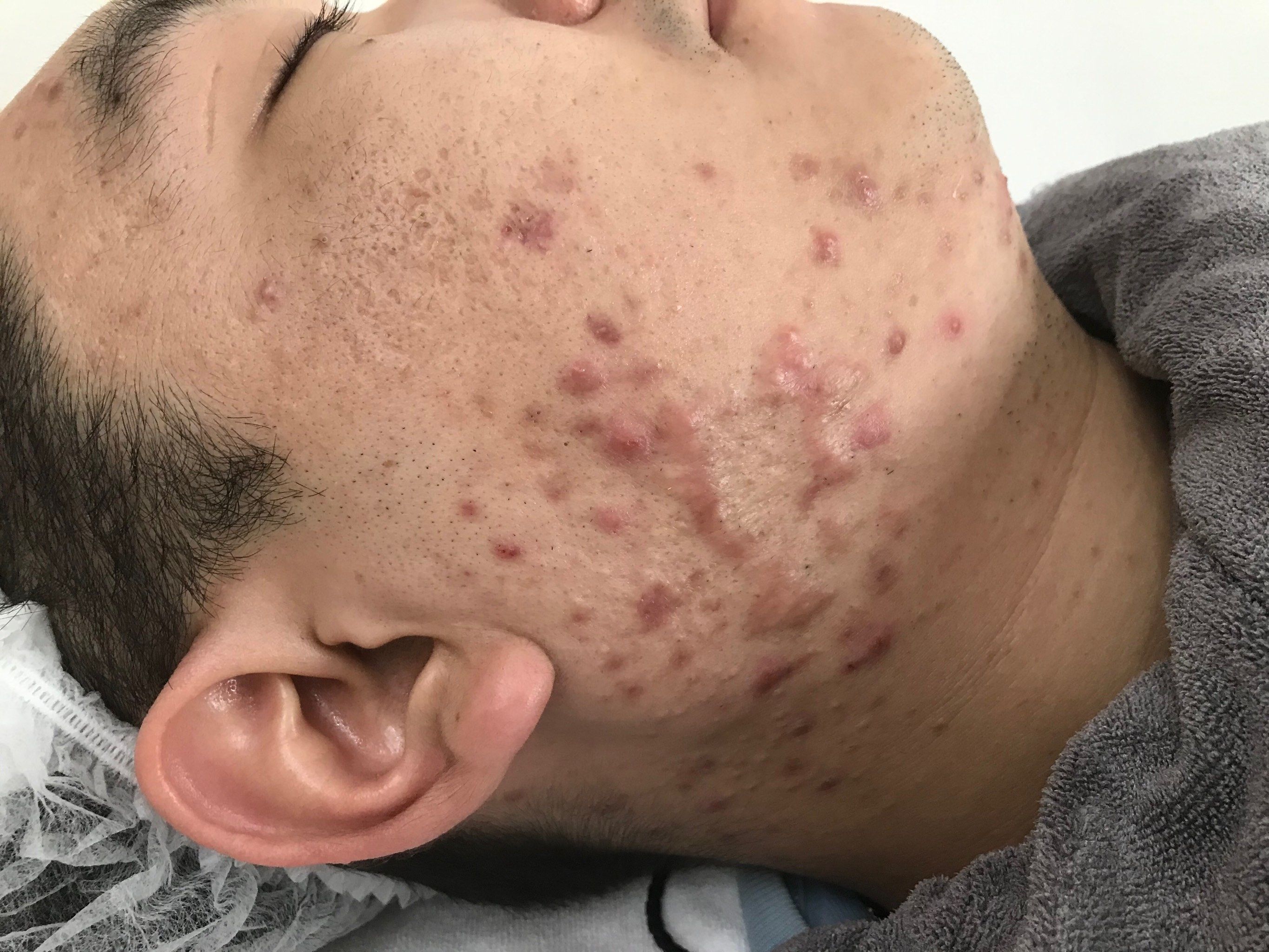 痘痘(痘痘的类型分为哪几种)