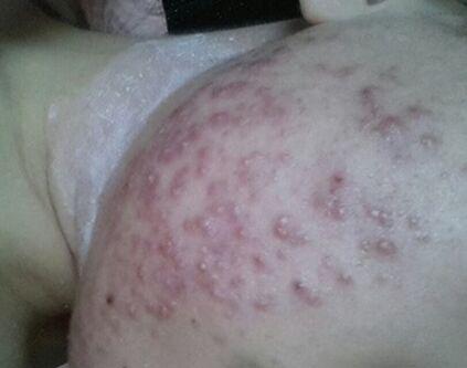 内分泌失调长痘痘怎么调理(内分泌失调脸上长痘痘了吃什么药)