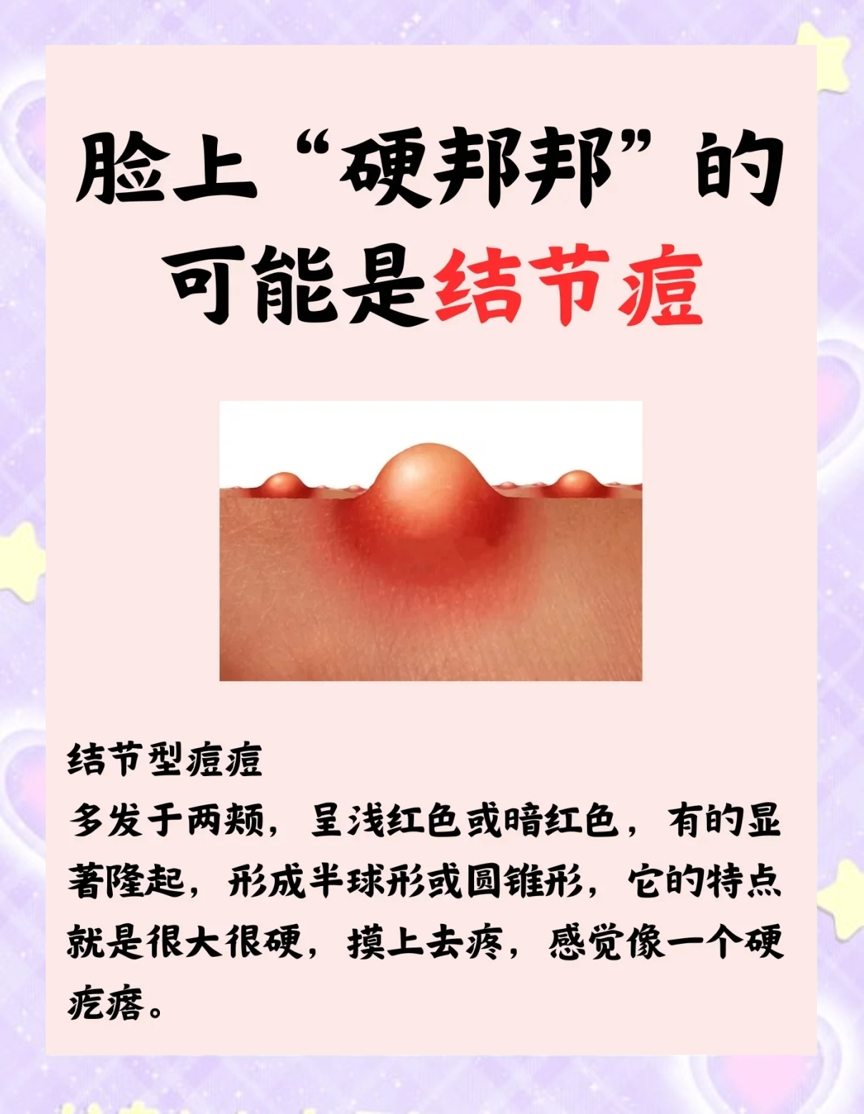 下颚长痘痘的原因(下颚线两侧长痘痘是什么原因)