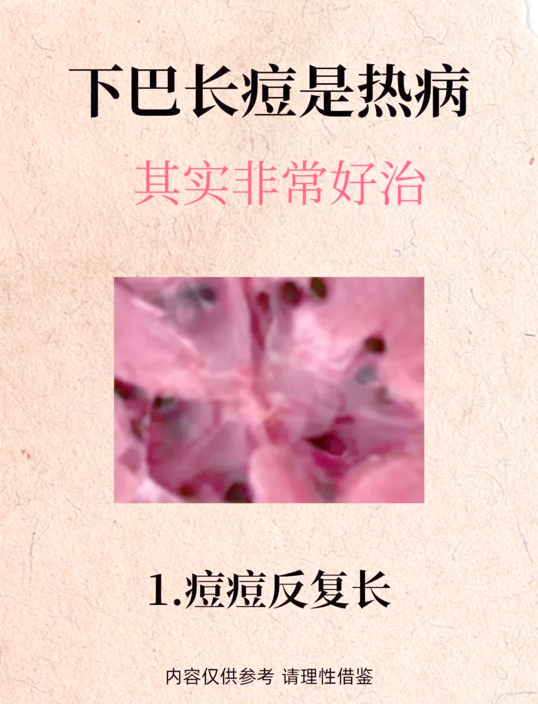 下颚长痘痘的原因(下颚线两侧长痘痘是什么原因)