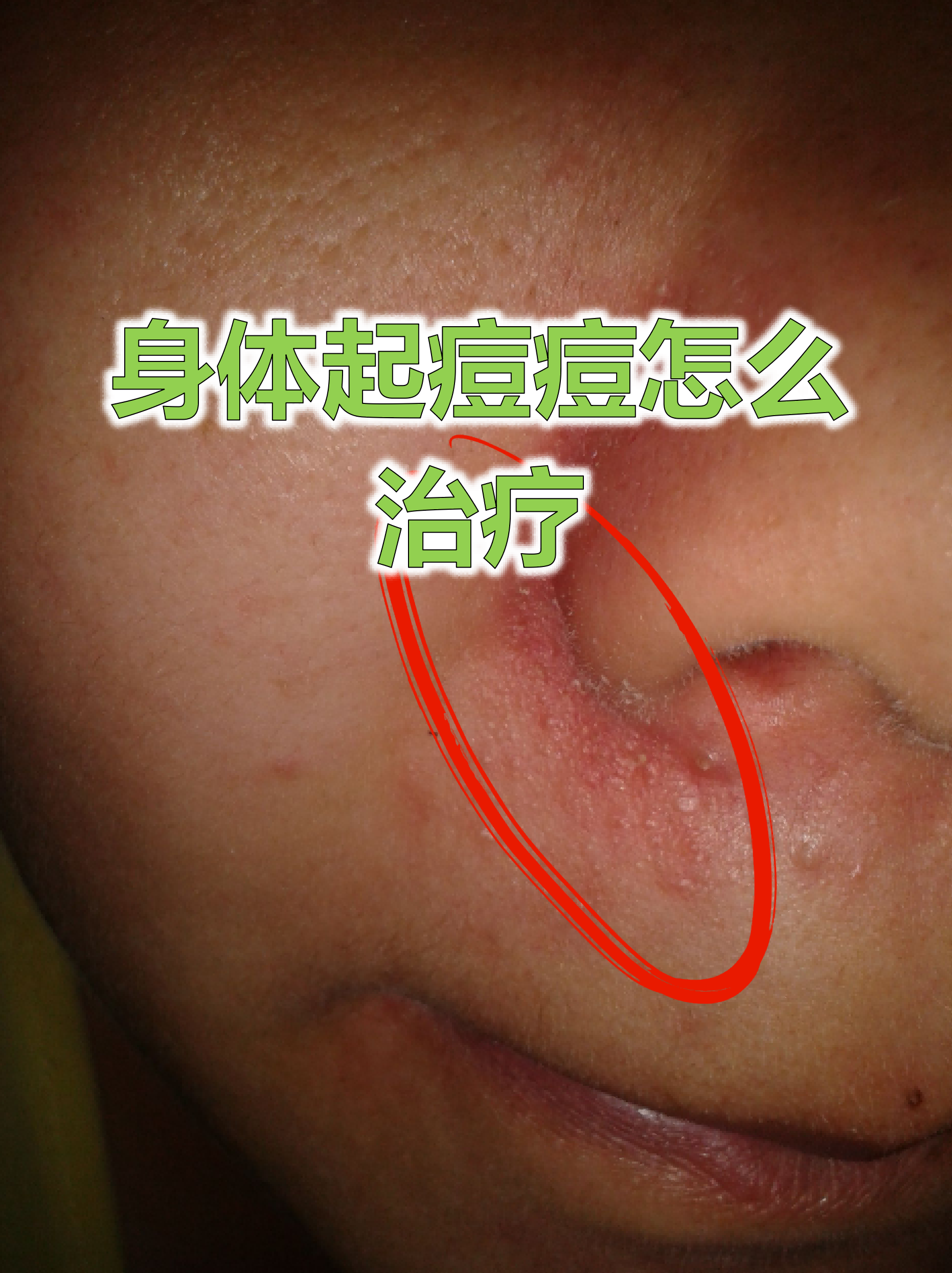 痘痘不挤自己会好吗(痘痘不挤掉会怎么样)