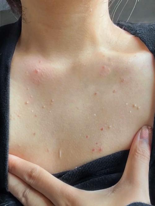 胸前长痘痘怎么回事(男的胸前长痘痘怎么回事)