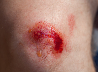 胸口长红色的小痘痘(胸口长红色的小痘痘用什么涂)