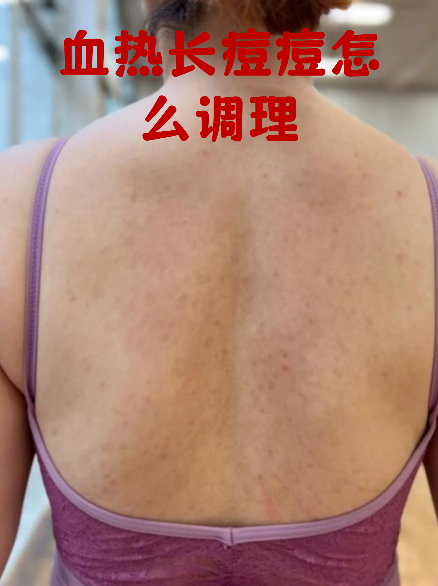 血热长痘痘怎么调理(血热长痘痘怎么调理用什么外用药好)