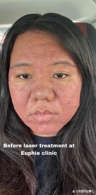 怀孕脸上长痘痘是什么原因(怀孕脸上长痘痘是什么原因是怀男孩吗)