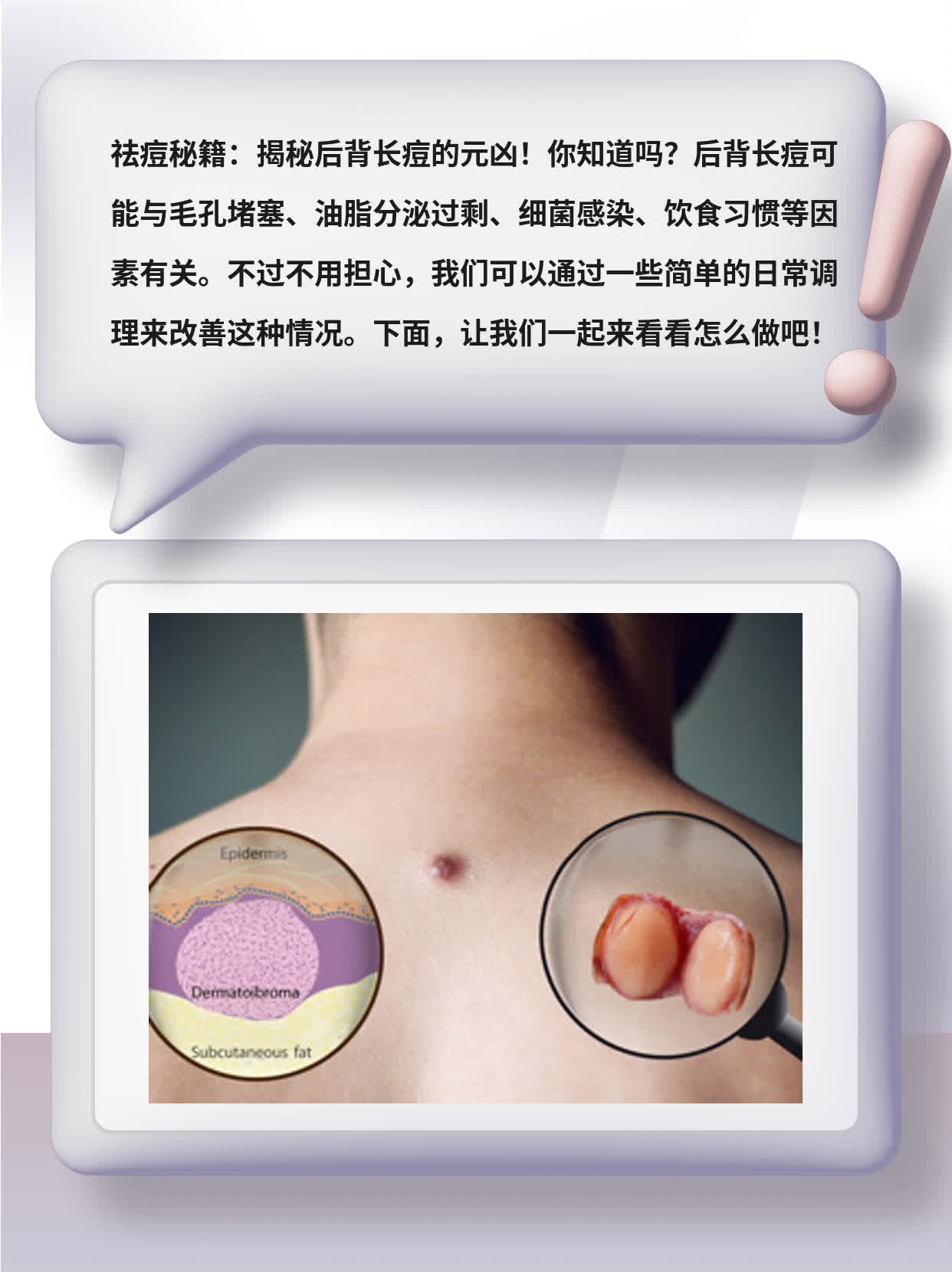 背部长痘痘是什么原因造成(男生后背长痘是梅毒吗)