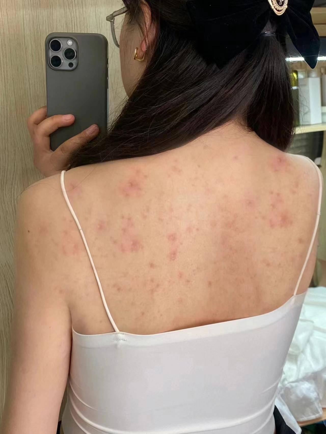 背部长痘痘是什么原因造成(男生后背长痘是梅毒吗)